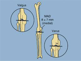 Blount S Disease Paley Orthopedic Spine Institute