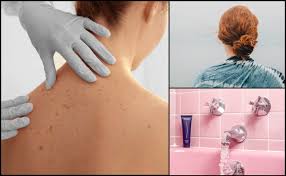 Jerawat memang menyakitkan, sama ada di wajah atau badan. Ramai Malu Sebab Ada Jerawat Belakang Badan Punca Sebab Berpeluh Ke Manis Madu