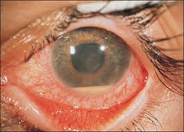 Image result for Ciliary Flush