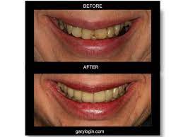 Full Mouth Reconstruction Condition Large Fillings In Back And Front Teeth Had Cracks And Cavities Garyrlogindmd Garylogin Cosmetic Dentistry Dentist Dental