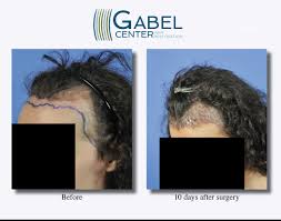 There are so many questions following a hair transplant. Watch A Patient S Real Time Growth After 3439 Grafts Gabel Center