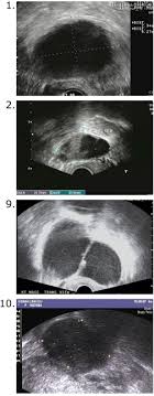 The ras family of genes, which makes proteins involved in cell communication pathways, cell growth, and then, the mistakes become mutations. Unexpected Epithelial Ovarian Cancers Arising From Presumed Endometrioma A 10 Year Retrospective Analysis Sciencedirect