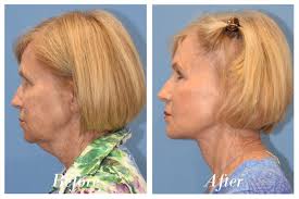 74-year-old 9 months s/p lamellar high-SMAS facelift, deep neck lift, upper  blepharoplasty, and fractional CO2 laser skin resurfacing of the face. I  find that many patients look better at 6+ months than