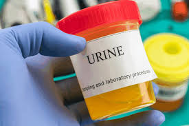 Image result for Urine Output