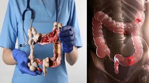 Câncer de intestino: conheça sintomas inusitados de alerta para doença..  ver mais nos comentários