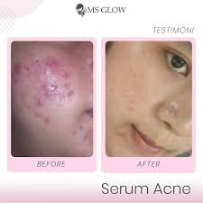 New The 10 Best Makeup With Pictures Positive Thinking Sabar Dan Telaten Adalah Kunci Psikologis Yang Tepat Untuk Penyembuhan Jerawat Serum Makeup Acne
