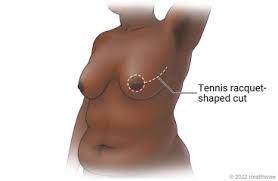 How Long After Breast Reduction Will I Know My Size? A Comprehensive Guide  | Radiance Plastic Surgery