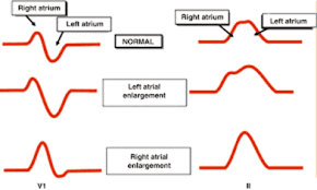 Image result for Cor Pulmonale