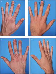Abbildung 1 Linke Hand Vor A Und Zwei Monate Nach Pdt B Rechte Download Scientific Diagram