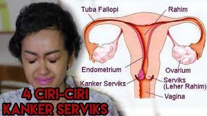 Kanker serviks merupakan salah satu dari sederet jenis kanker yang mematikan. 4 Ciri Ciri Kanker Serviks Yang Menyerang Jupe Wanita Wajib Share Youtube