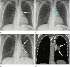 In stage 1 lung cancer, people usually do not experience symptoms. Deep Learning Algorithm Identifies More Missed Lung Cancers On X Ray