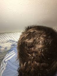 Dutasteride has been shown to treat and prevent hair loss. Topical Dutasteride Saved My Hair T Replacement Forums T Nation