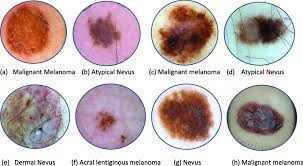 The dermis is the second layer, thicker, while the l. An Example Of Skin Lesions Dataset Utilized In The Development Of Download Scientific Diagram