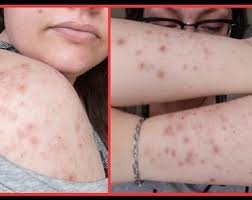 Image result for Neurotic Excoriation