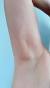 Cancer Lump In Armpit