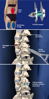 Pin On Surgical Procedures At Southeastern Spine