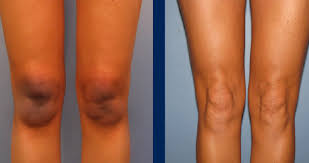 I will also give you a few e. Natural Ways To Lightens Dark Knees And Elbows Video How Nigeria News