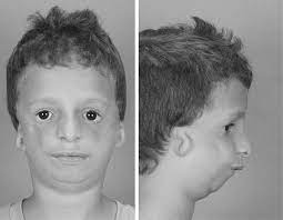 Scielo Brasil Traz A Deformidade De Orelha Impacto Negativo Na Qualidadede Vida Em Individuos Com Sindrome De Treacher Collins Traz A Deformidade De Orelha Impacto Negativo Na Qualidadede Vida Em