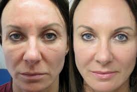 الفرق بين ابر النضاره و البلازما للوجه بشرة وشعر skin grafting botox injections aging process