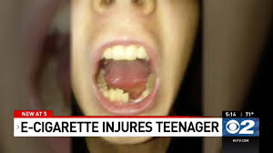 Granted, the odds that your vape pen will blow up like an exploding cigar are slim. Kutv 2news E Cigarette Explodes In Teen S Mouth Breaks Jaw And Teeth Facebook
