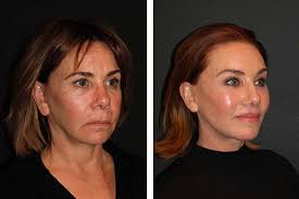Best Facelift Surgeon In America Best Face Lift Surgeon