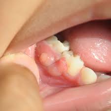 Maybe you would like to learn more about one of these? Mengenal Gum Boil Penyebab Gusi Bengkak Dan Bernanah