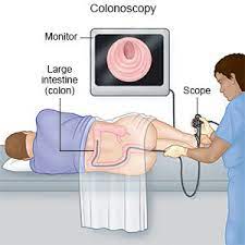 Find out the cost of colonoscopy only at lybrate. Colonoscopy Discharge Care What You Need To Know