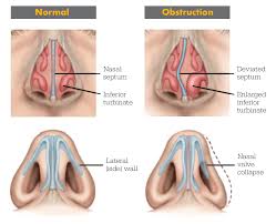 Nasal Airway Obstruction Ent Stryker