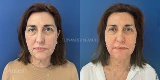 Cheek Augmentation