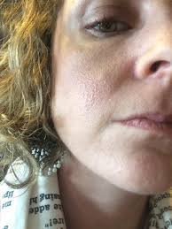 Orange peel skin on the chin can be more dramatic with textural changes and pitting. Skin Concern Orange Peel Texture Update Skin Orange Peel Texture Skin Concern