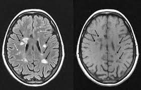 هذا التلف أو التآكل للغشاء يؤثر سلبا على عملية الاتصال ما بين الدماغ وبقية. Ø§Ø´Ø±Ø§Ù‚Ø© Ø£Ù…Ù„ Ù„Ù„ØªØµÙ„Ø¨ Ø§Ù„Ù„ÙˆÙŠØ­ÙŠ Ø§Ù„Ù…ØªØ¹Ø¯Ø¯ Posts Facebook