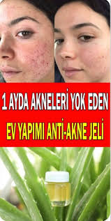 Aloe Veranin Cilde Saca Ve Sagliga Faydalari Nelerdir Sivilce Izi Dogal Akne Tedavisi Akne Tedavisi
