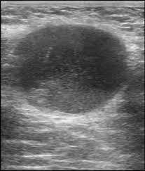 Breast cancer is a form of cancer that occurs in your breast(s). Male Breast Cancer Radiology Case Radiopaedia Org