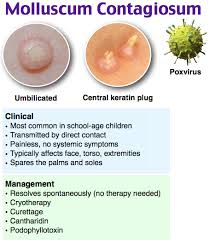 There are many treatments for molluscum found on the shelves of the drugstore. Molluscum Contagiosum Pediatric Nurse Practitioner Pathophysiology Nursing Clinical Nurse Specialist