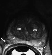 Doctors who specialize in treating cancers with radiation are known as radiation oncologists. Mr Imaging In Local Staging Of Prostate Cancer European Journal Of Radiology