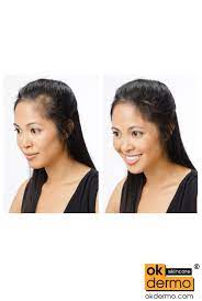 Hair growth serum, votala hair growth treatment, hair serum, anti hair loss, thinning, balding, repairs hair follicles, promotes thicker, stronger hair, and promotes my sister has been using this hair oil for the past 6 months and has started to see reduction on hair fall with continuous use. Kera Xl Hair Growth Serum 60ml 2fl Oz Okdermo Skin Care