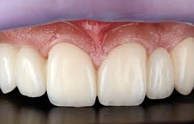 Image result for ochrana chrupu