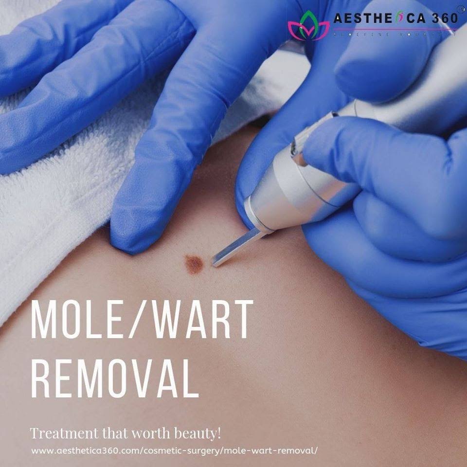 Mole & Wart Removal product image