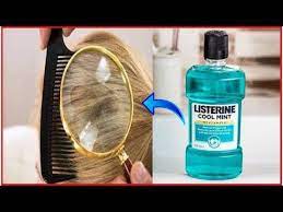 How To Get Rid Of Lice With Vinegar And Listerine Fast At Home Youtube Listerine Home Lice Remedies Head Louse