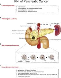 We will also consider some treatment options as well. New Insights Into Perineural Invasion Of Pancreatic Cancer More Than Pain Sciencedirect