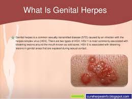 Herpes simplex (hsv) encephalitis is the most common cause of fatal sporadic fulminant necrotizing viral encephalitis and has characteristic imaging findings. Genital Herpes In Women