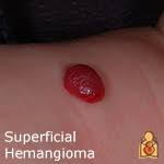 In patients with liver disease, your liver can't metabolize estrogen, so the. Infantile Hemangiomas About Strawberry Baby Birthmarks Healthychildren Org