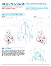 Infographic Aortic Valve Replacement Http Www Columnfivemedia Com Work Items Infographic Aort Aortic Valve Replacement Bicuspid Aortic Valve Cardiac Nursing