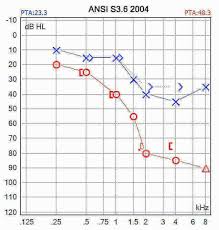 understanding your audiogram