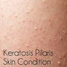 Image result for Keratosis pilaris