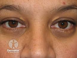 Image result for xanthelasma of eyelid