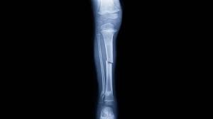 We did not find results for: Tratamiento De Fractura De Tibia Enfoque No Quirurgico Y Quirurgico