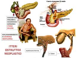 I tumori benigni sono rari, rappresentando dal. Itteri Ostruttivi Neoplastici