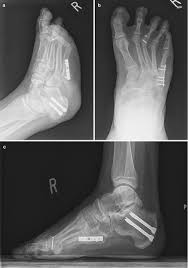 Treatment may involve surgery, and recovery can take up to four months. Revision Surgery For 5th Metatarsal Fractures Springerlink