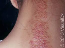 Image result for Lichen Simplex Chronicus